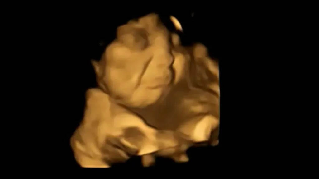 Una imagen de escáner 4D del mismo feto que muestra una reacción de cara de molestia tras ser expuesto al sabor del kale. Crédito: FETAP/Laboratorio de Investigación Fetal y Neonatal/Universidad de Durham