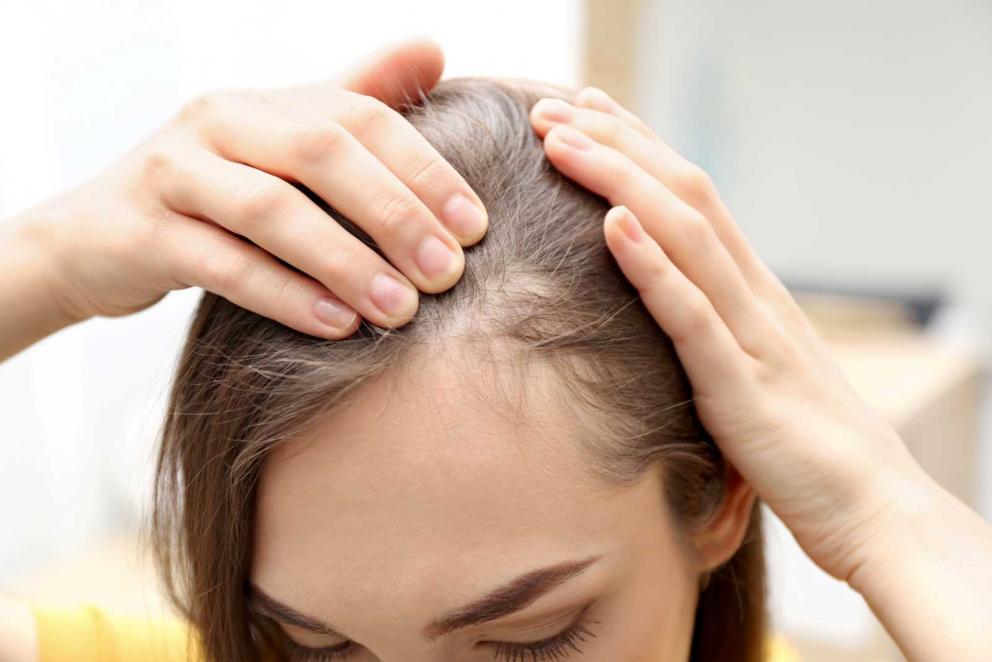 Lo que necesitas saber sobre la alopecia